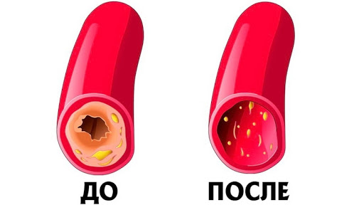 Медики рассказали: как почистить сосуды дома без лекарств